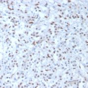FFPE human mesothelioma sections stained with 100 ul anti-Wilms Tumor 1 (clone WT1/857) at 1:300. HIER epitope retrieval prior to staining was performed in 10mM Citrate, pH 6.0.
